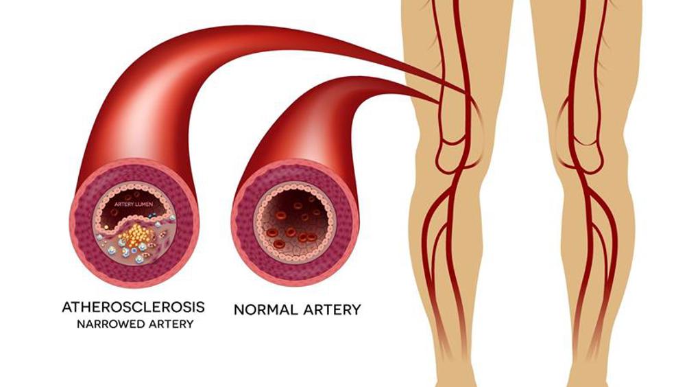 Masters of Circulation: The Expertise of Peripheral Artery Disease Specialists